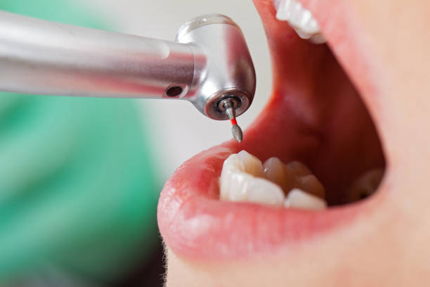 Best Emergency Dentist for Lost Fillings or Crowns in Matta, WA